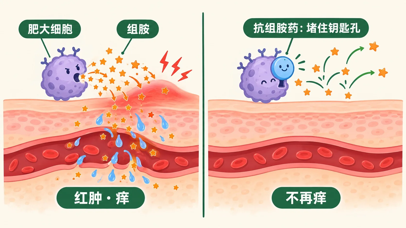 肥大细胞释放组胺与抗组胺药堵受体